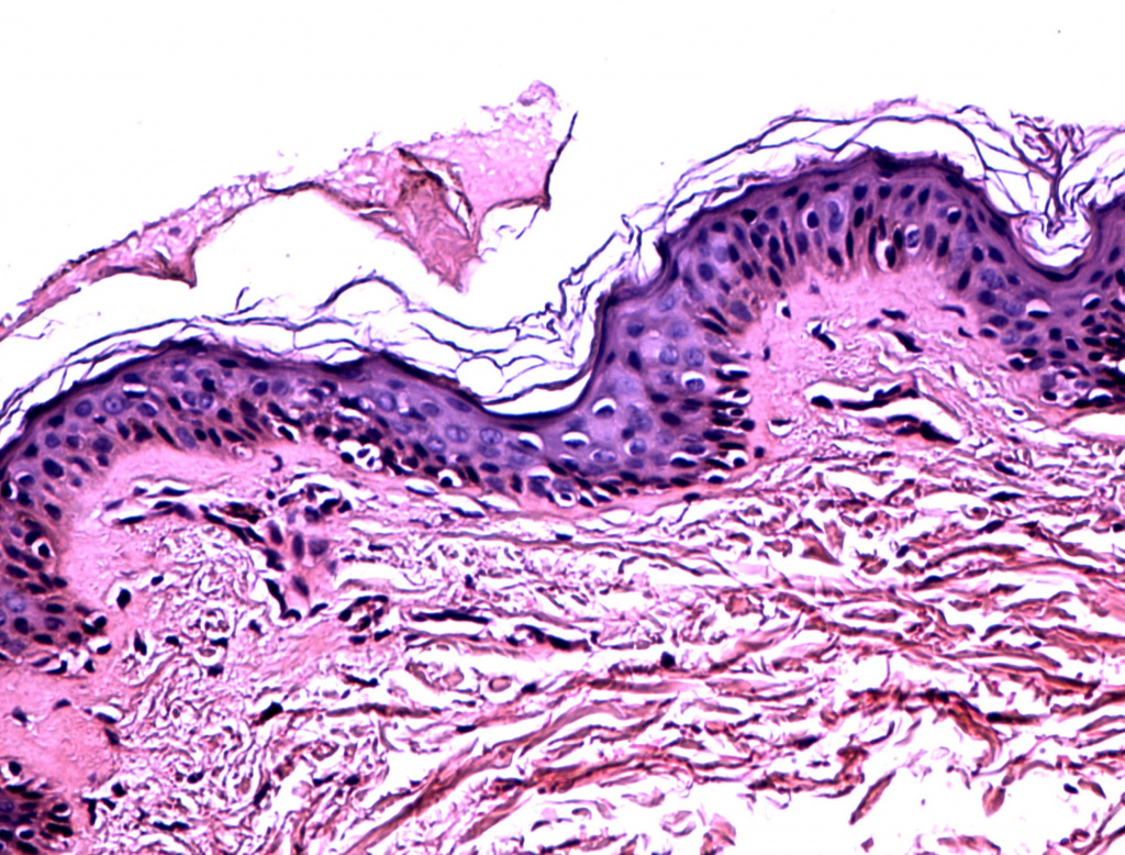 Гистология через 20 дней после процедуры HELEO4